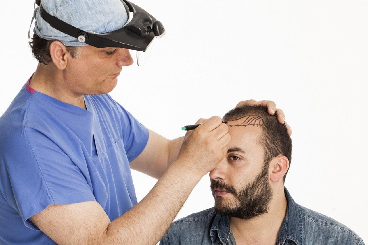 Hair Transplant in Turkey: The Ultimate Guide