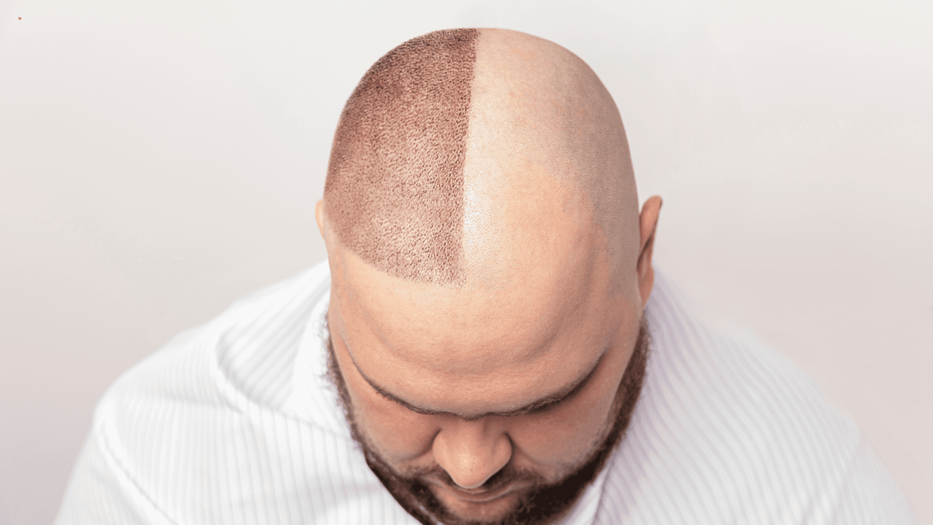 Are Hair Transplants Safe? What Science and Experts Say