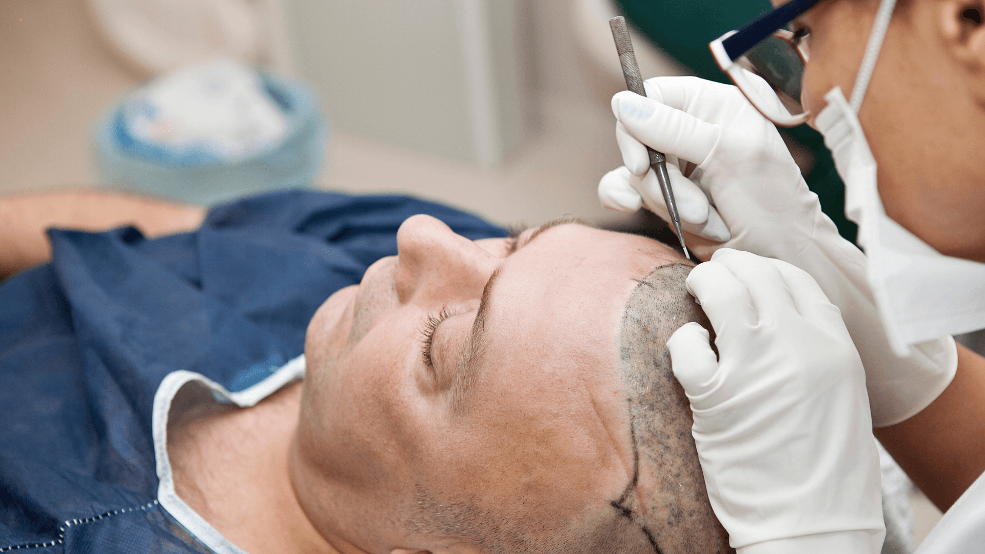 The Biggest Mistakes to Avoid After a Hair Transplant