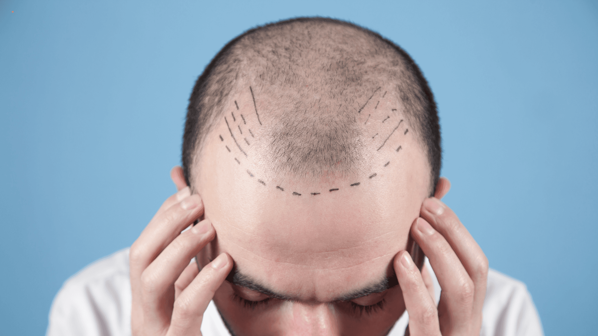 Is DHI or FUE Better? The Ultimate Hair Transplant Comparison with Real Patient Results