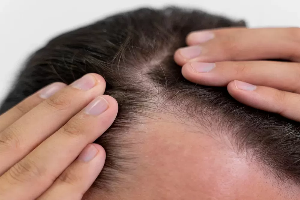 Why Do Men Lose Their Hair? The Science Behind Hair Loss
